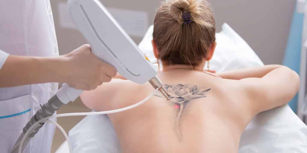 LASER TATTOO REMOVAL ✔️ Tattoos used to be considered permanent, but thanks  to advances in laser technology, today's lasers can get rid of tattoos  more... | By ClassyNails Co.Facebook