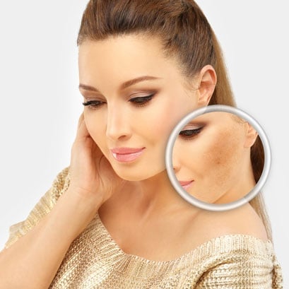 Melasma Removal Before & After Pictures