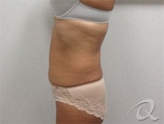 Fat Loss Before & After Photos