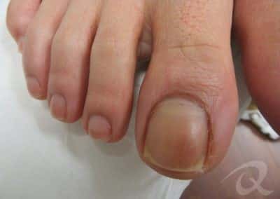 Fungal Nail Treatment Before & After Picture aaa2