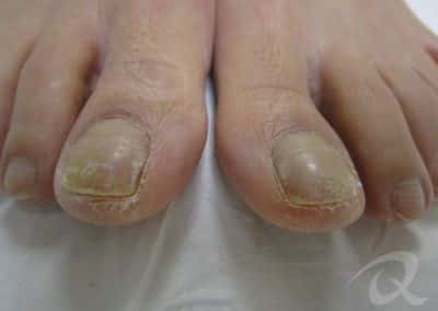 Fungal Nail Treatment Before & After Picture bb1