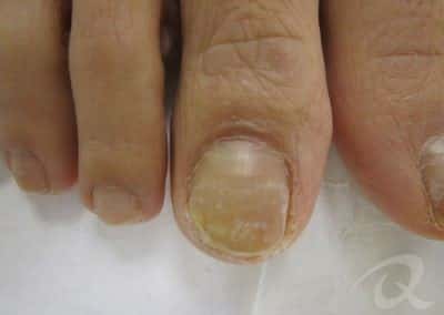 Fungal Nail Treatment Before & After Picture bbb2