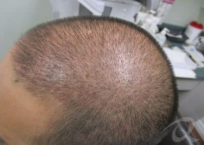 Hair Loss Before & After