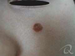 Mole Removal Before & After Photos