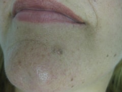 Mole Removal Before & After Photos