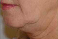 Skin Tightening Before & After Photos