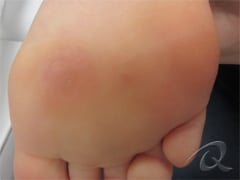 Wart Removal Before & After