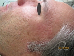 Acne Scarring Treatment Before & After Photos