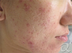 Acne Scarring Treatment Before & After Photos