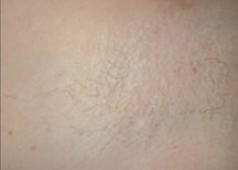 Laser Hair Removal Before & After Photos