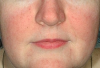 Rosacea Before & After Photos
