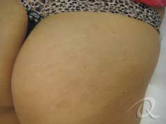 Stretch Mark Removal Before After Photos