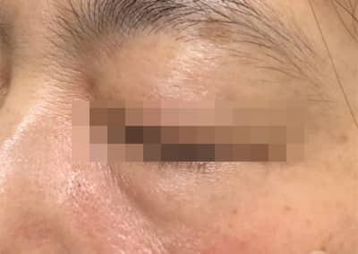 Dark circle eyes before after pictures
