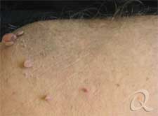 skin tag removal before after picture