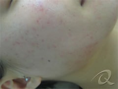 Acne before after pictures