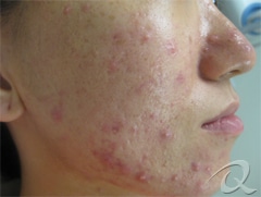 Acne before after pictures