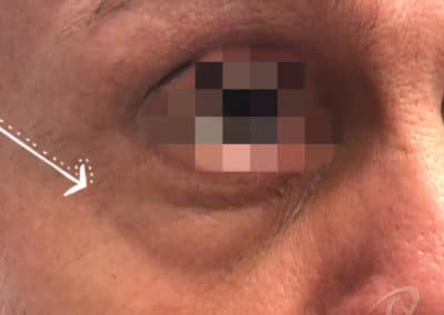 Eye bag before after photo