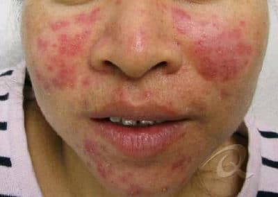 Acne Treatment Before After Pictures