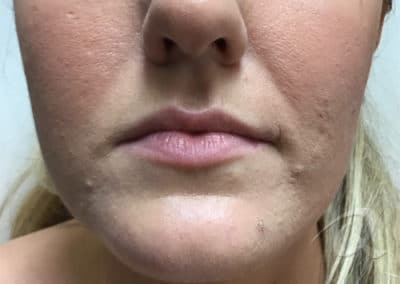Fillers Injection Before & After Pictures