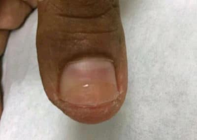 Wart Before & After Pictures