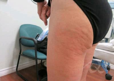 Cellulite Before & After Pictures