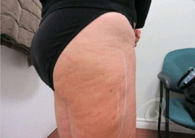 Cellulite Treatment Before After Pictures