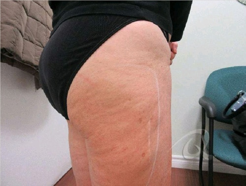 Anti-cellulite treatments - Before and After - Sculpturelle
