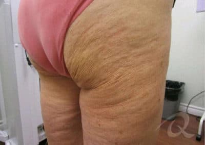 Cellulite Reduction Before After Pictures
