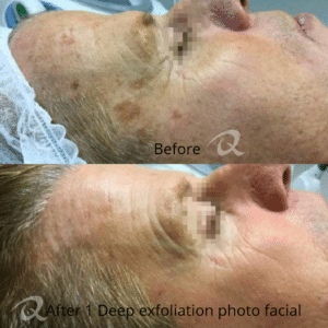 Before and After of Deep Exfoliating Photo Facial