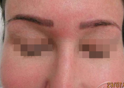 Permanent Makeup Removal Before and After Photos