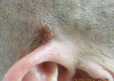 Mole Removal Before & After Pictures 30