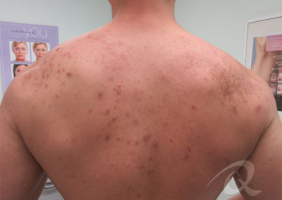 Back acne before after picture 1