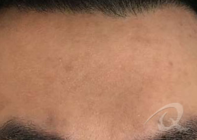 acne scar removal after picture
