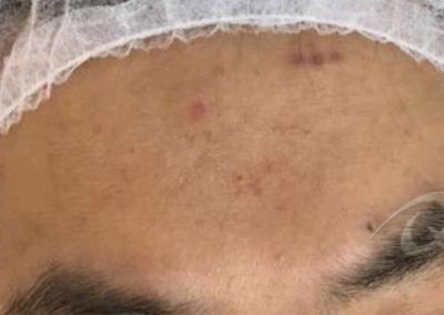 acne scar removal before picture
