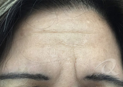wrinkles removal before pictures