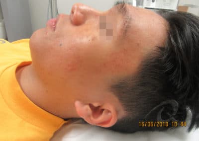 Acne before after picture