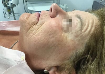 Age spots removal before/after pictures