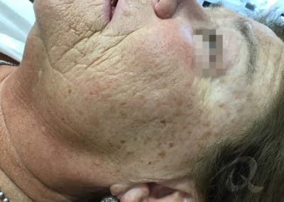 Age spot removal before/after photo