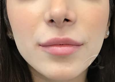 Derma Fillers Before & After Photo