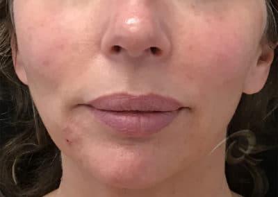Derma Fillers Before & After Pictures a2