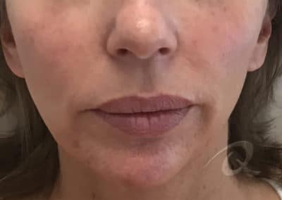 Derma Fillers Before & After Photos b2