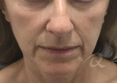 Derma Fillers Before & After Pictures b3