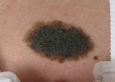 Birthmark Removal Before & After Picture