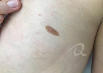 Birthmark Removal Before & After Picture bb11