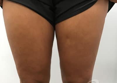 Cellulite Reduction Before & After Photos a1-1