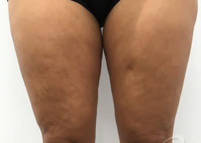 Cellulite Reduction Before & After Pictures b1-1