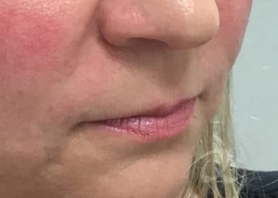 Fillers Before & After Photo a1