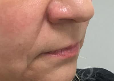 Fillers Before & After Pictures