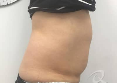 Fat Loss Treatment Before & After Photo a1