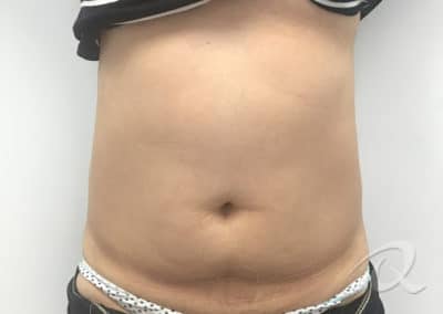 Fat Removal Before & After Photos a2-1